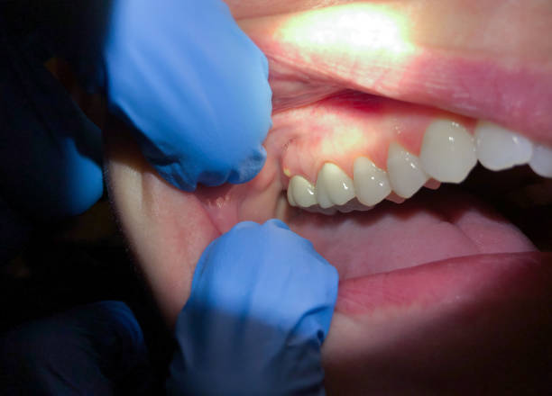 Best Emergency Tooth Extraction  in Ransom Canyon, TX