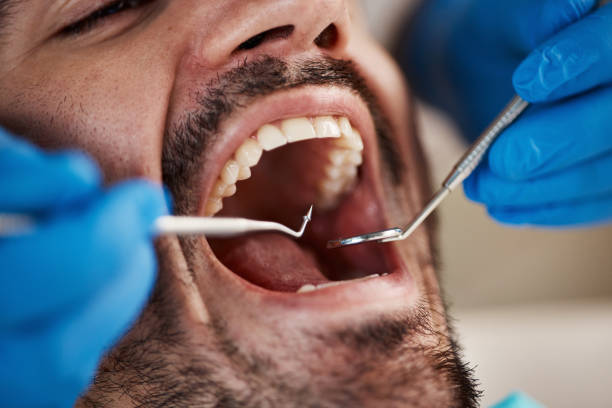Best Knocked-Out Tooth Emergency  in Ransom Canyon, TX